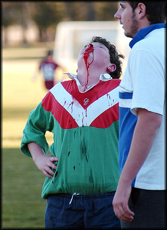 Broken Nose